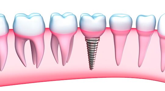 Dental Implant With Root Shown