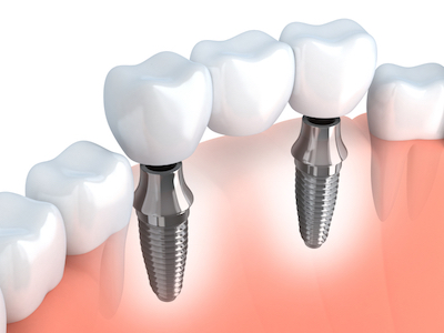 Image of a dental implant bridge that replaces 3 teeth between natural ones.