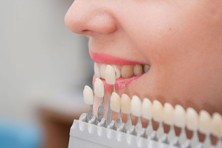 Image of a patient going through a tooth color matching process for cosmetic dentistry dental veneers.