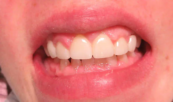 After image